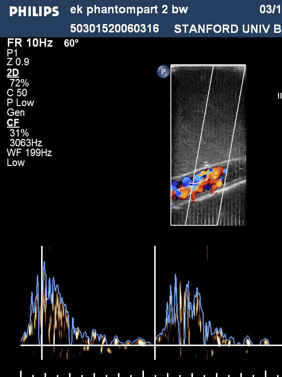 Ultrasound Imaging in Vascular Phantom