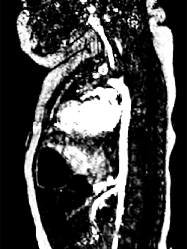 Magnetic Resonance Imaging of Thoracic Cavity in an Infant
